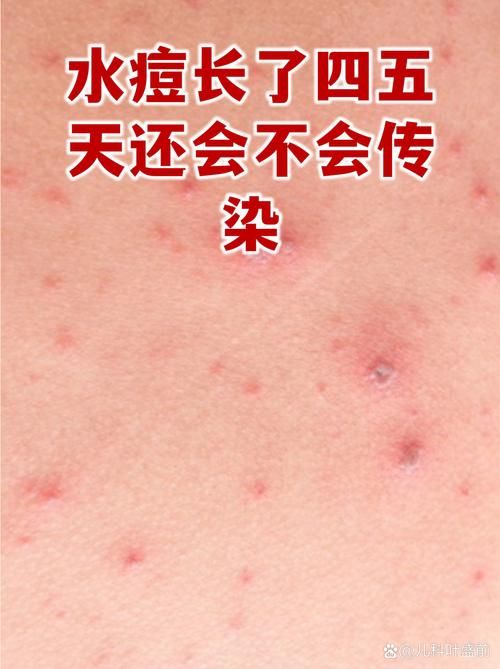 专家:渝水区每年或现多个感染高峰(渝水区疫情防控)