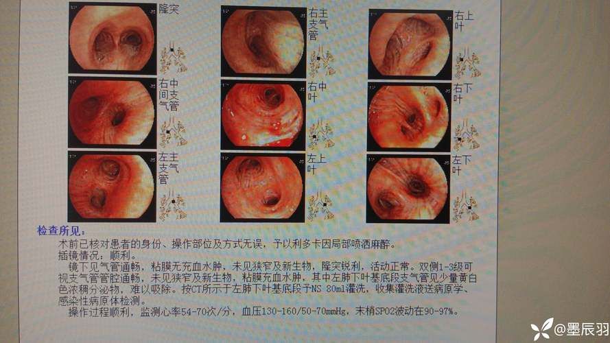 志丹县累计报告境外输入11例(志丹是否发现一例新冠病毒)