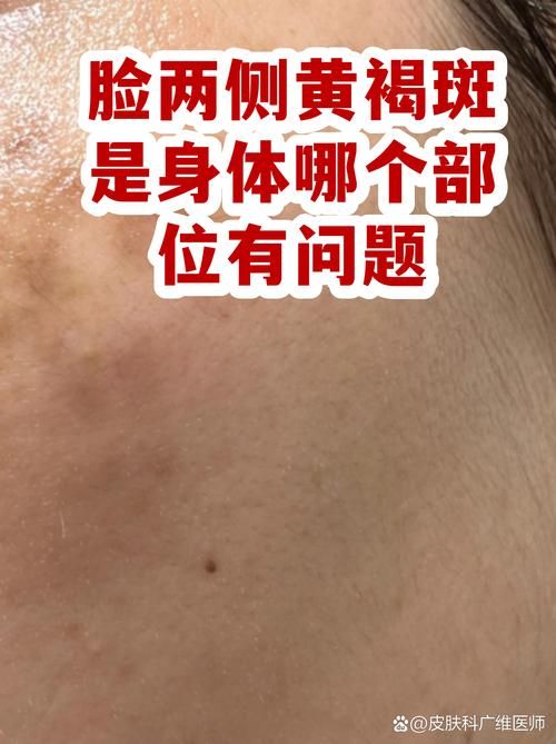 渝水区疫情防控中风险地区/脸上长黄褐斑看什么科